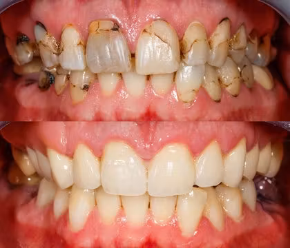 Close-up of teeth showing improvement